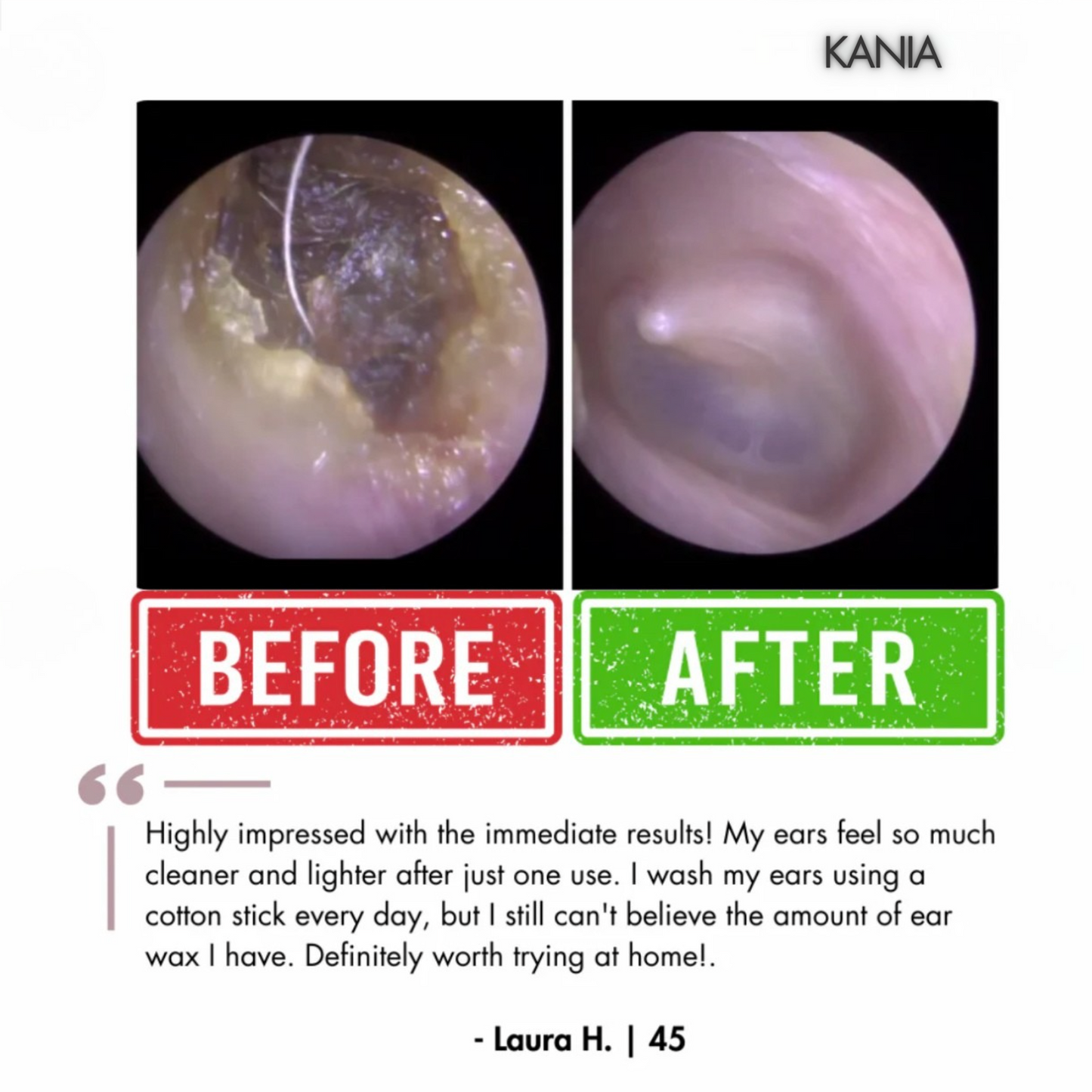 KANIA™ Electric Ear Wax Removal Kit